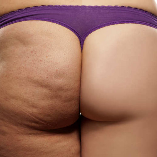 Mesotherapy for cellulite