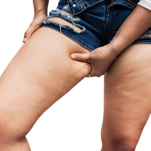 Causes of cellulite