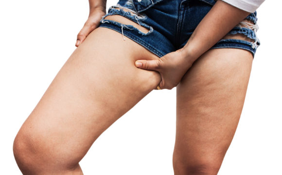 Causes of cellulite