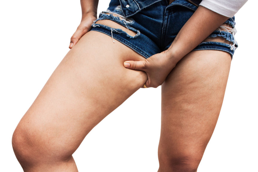 Causes of cellulite