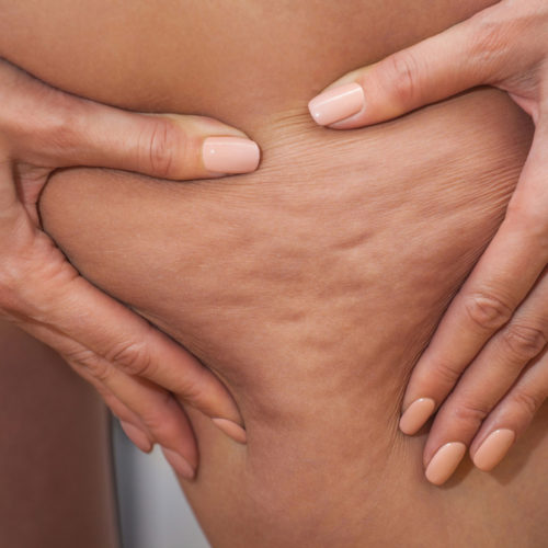 Cellulite: Buttocks, thighs and localised fatty deposits