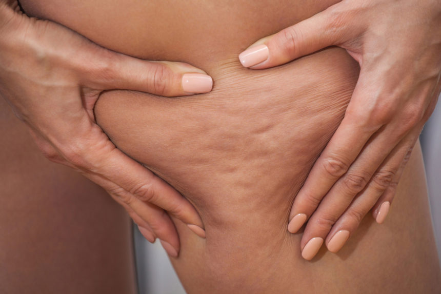 Cellulite: Buttocks, thighs and localised fatty deposits