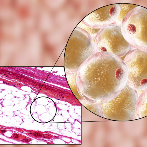 Localised Adiposity and Edematous Fibrosclerotic Panniculopathy (EFP)