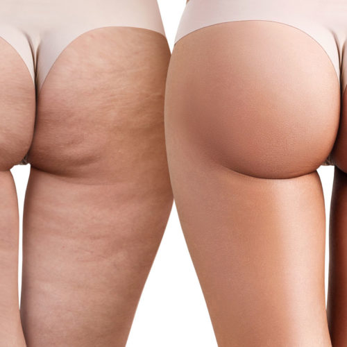 Reducing cellulite