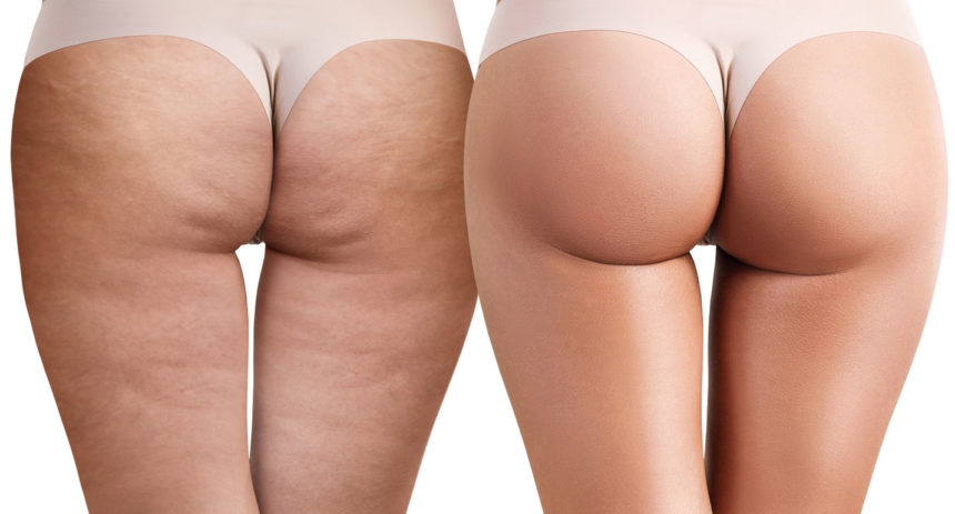 Cellulite: the right combination for combatting it