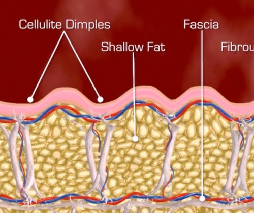 Fibrous septae and cellulite