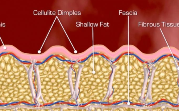 Fibrous septae and cellulite