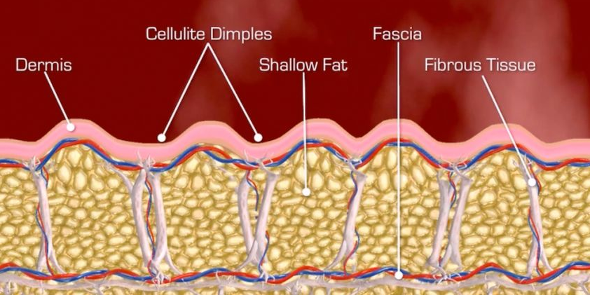 Fibrous septae and cellulite